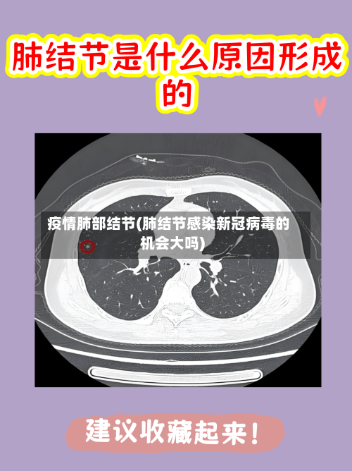 疫情肺部结节(肺结节感染新冠病毒的机会大吗)