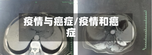 疫情与癌症/疫情和癌症