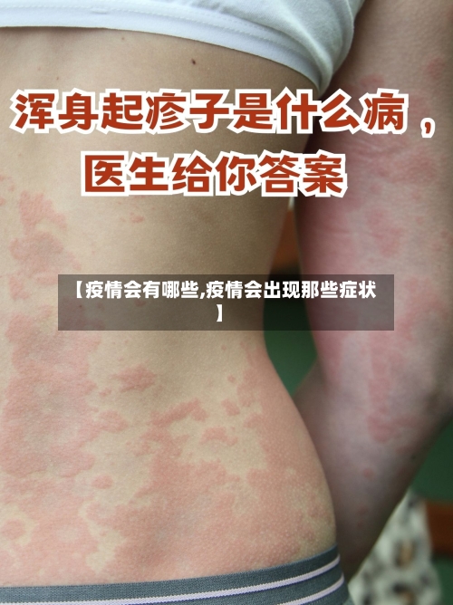 【疫情会有哪些,疫情会出现那些症状】
